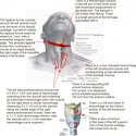 Zahau head injuries anterior internal REV.jpg