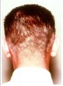 Syphilis Moth Eaten Hair Loss.JPG