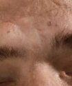 UID61651scarring.jpg