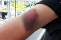 Bruise.JPG