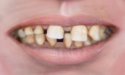 Davie 1975 Canal Girl Teeth.jpg