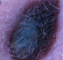 close-up-of-back-wound.jpg