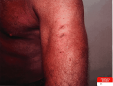 BM-scratches-on-arm.png