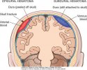 epidural-hematoma-1 (resize).jpg