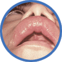 anaphylaxis.gif