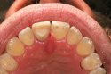 Internal-External-Bleaching-08.jpg