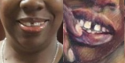 veverly mitchell and butts county GA UID teeth.png