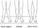 varus-and-valgus.jpg