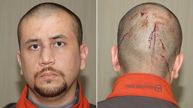 ht_george_zimmerman_injuries_ll_120517_wg.jpg