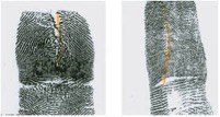 The vertical cut or slice modifies the fingerprint by scarring or distorting. Individuals cut down the middle of the fingertip, leaving a fairly straight cut on the fingerprint. In some instances an individual will pull the skin near the cut in different directions in an effort to generate an unusual fingerprint pattern when the fingertip heals.